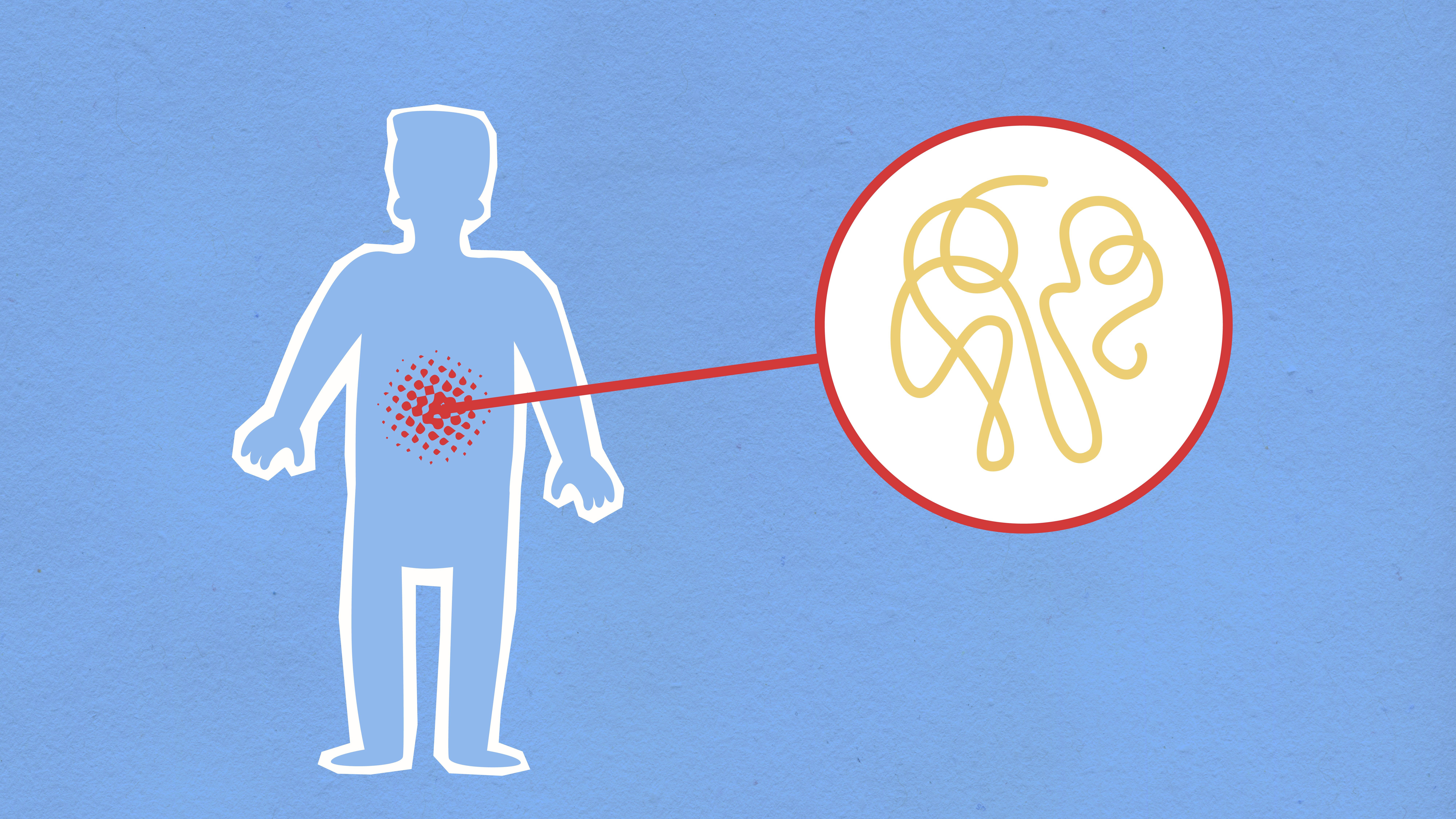CDC Investigates New Cyclospora Outbreak After 72 Illnesses Reported